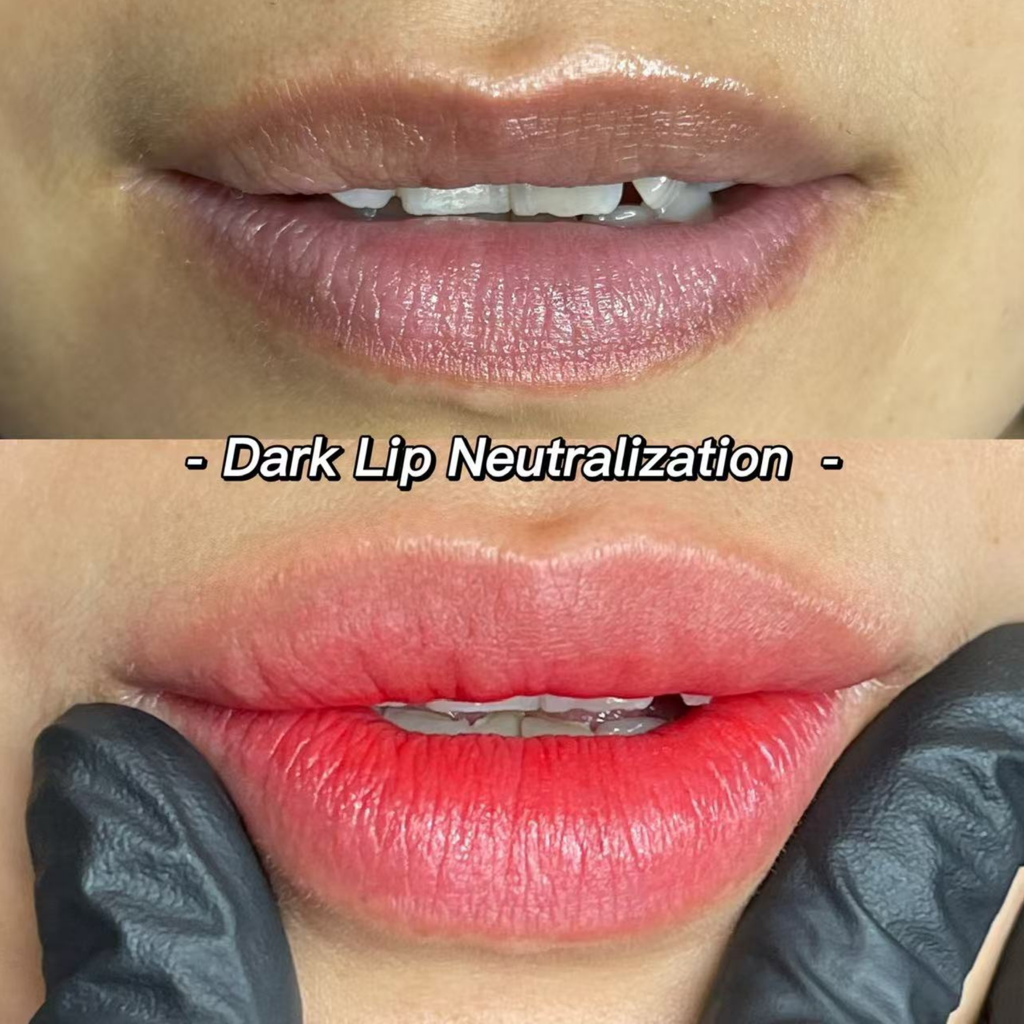 Dark Lip Neutralization treatment in Rochester Hills Michigan