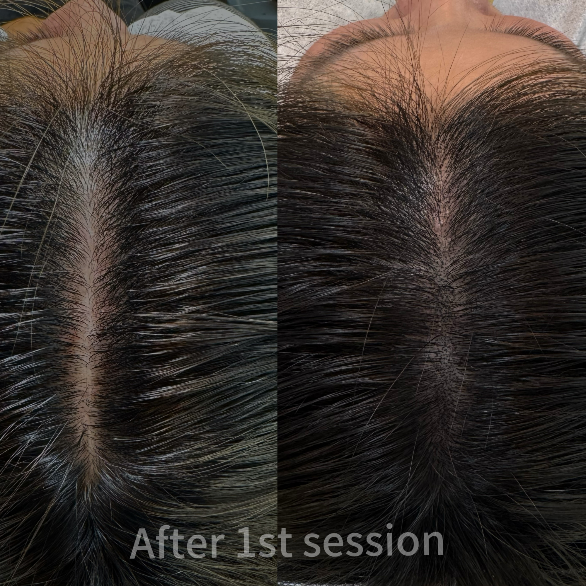 SMP Female Density Fill-In treatment in Rochester Hills Michigan