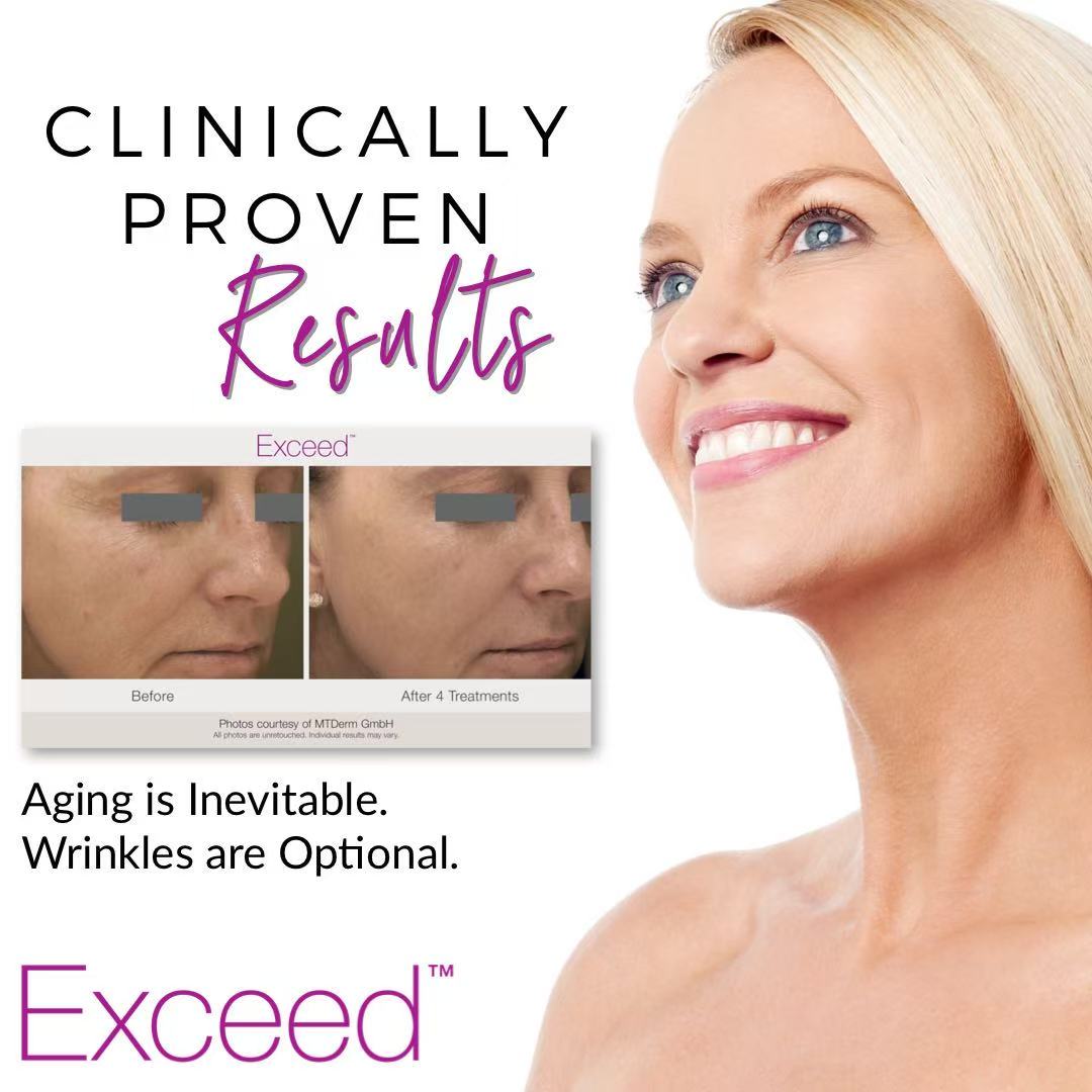 Exceed Microneedling for wrinkles in Rochester Hills Michigan