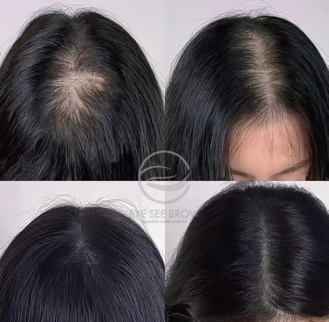 Hairline/Crown SMP example