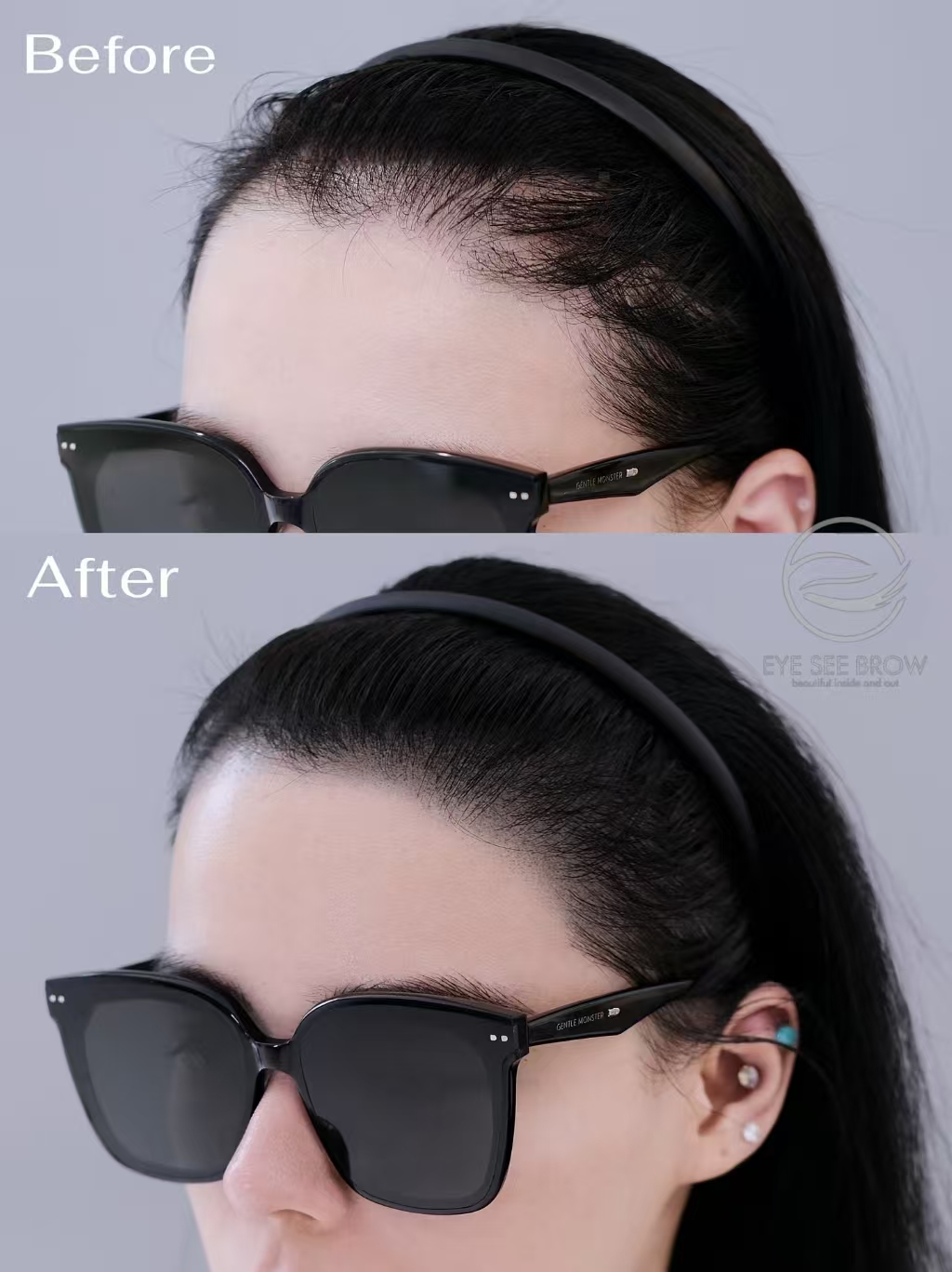 Hairline/Crown — 1