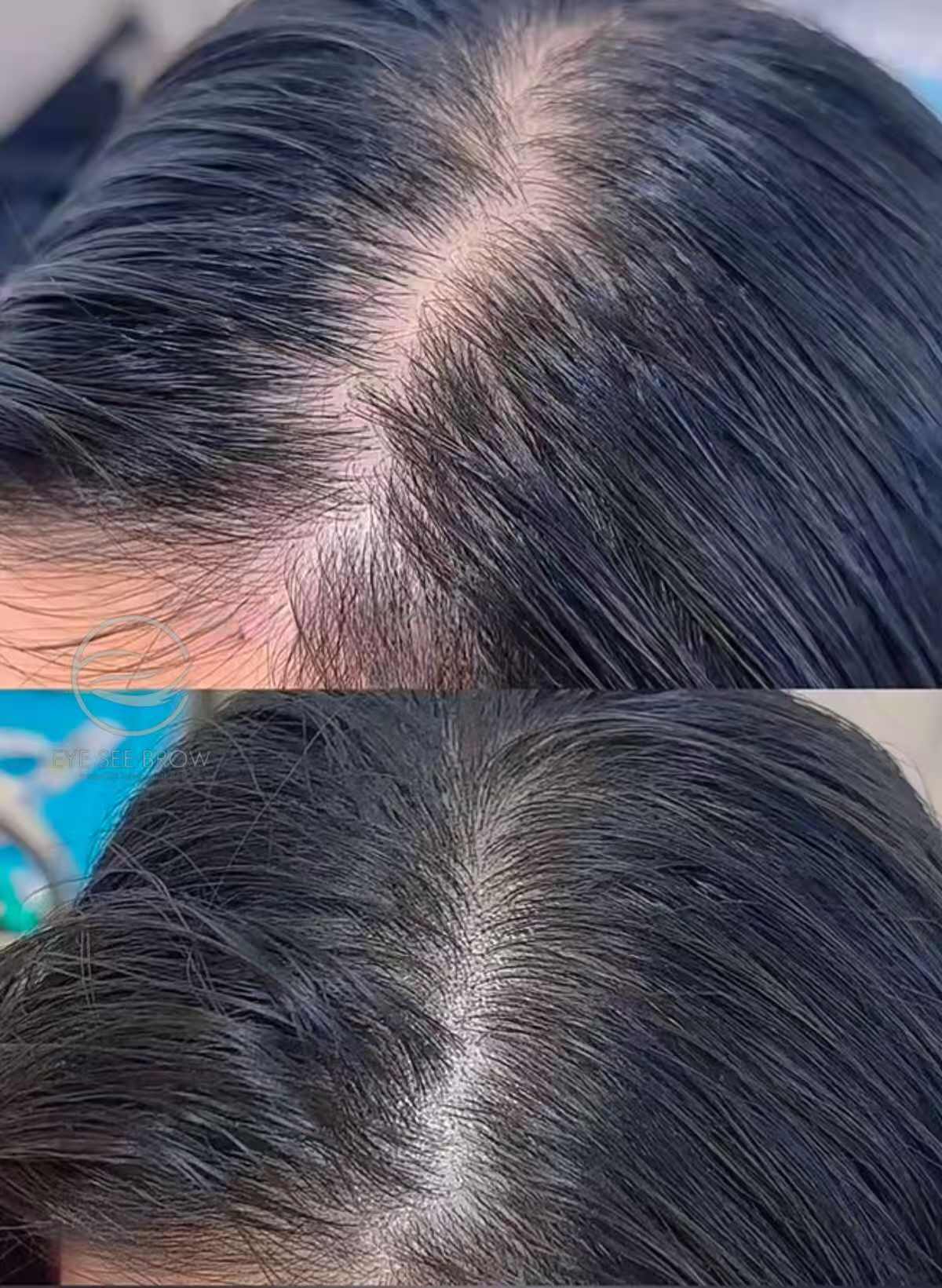 Hairline/Crown — 3