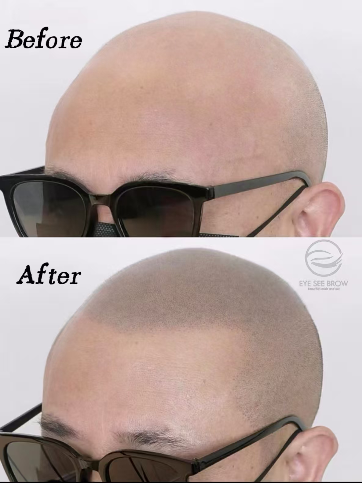 Full scalp SMP example